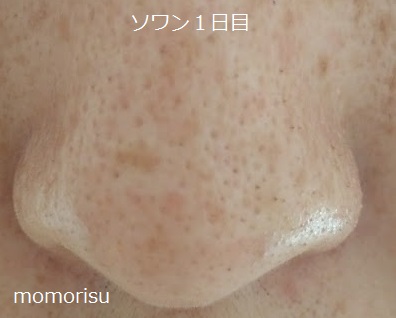 ソワンを使った毛穴の様子1日目