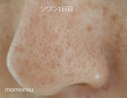 ソワンを使った毛穴の様子左側1日目