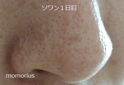 ソワンを使った毛穴の様子右側1日目