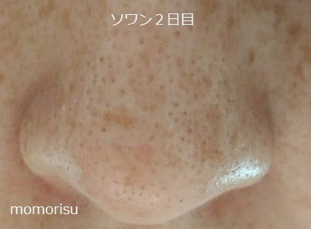 ソワンを使った毛穴の様子2日目