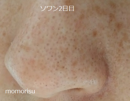 ソワンを使った毛穴の様子左側2日目