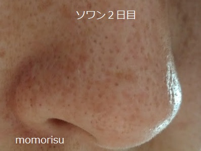 ソワンを使った毛穴の様子右側2日目