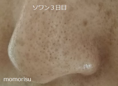ソワンを使った毛穴の様子左側3日目