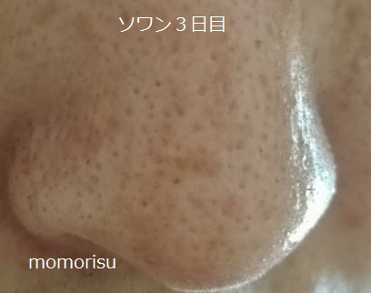 ソワンを使った毛穴の様子右側3日目