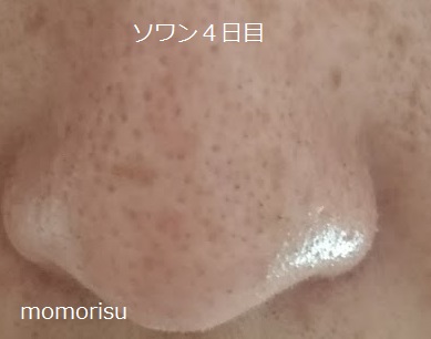 ソワンを使った毛穴の様子4日目