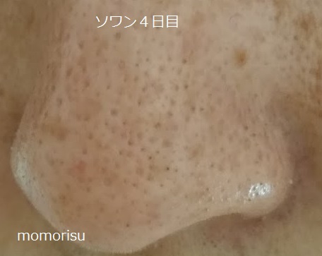 ソワンを使った毛穴の様子左側4日目