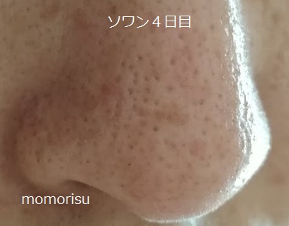 ソワンを使った毛穴の様子右側4日目