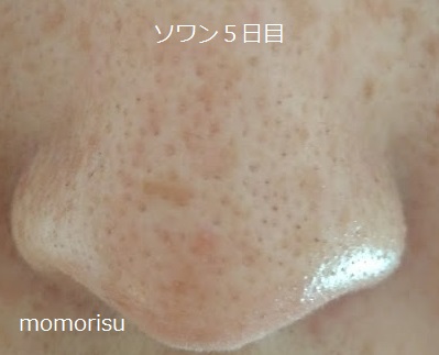 ソワンを使った毛穴の様子5日目
