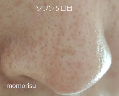 ソワンを使った毛穴の様子右側5日目