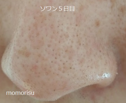ソワンを使った毛穴の様子左側5日目