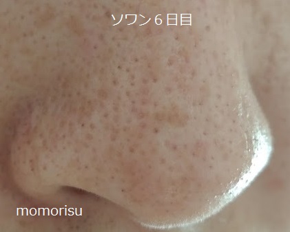 ソワンを使った毛穴の様子右側6日目