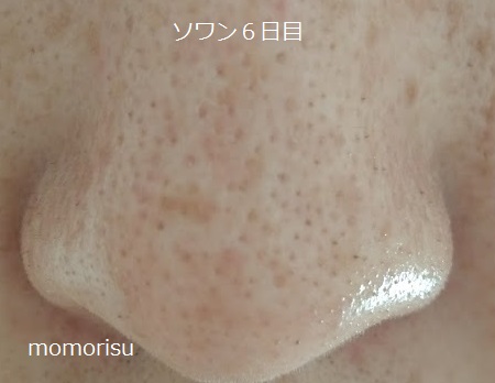 ソワンを使った毛穴の様子6日目