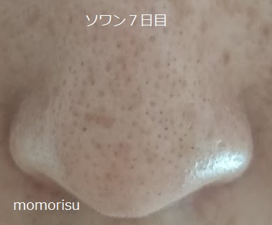 ソワンを使った毛穴の様子7日目