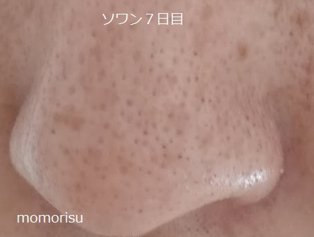 ソワンを使った毛穴の様子左側7日目