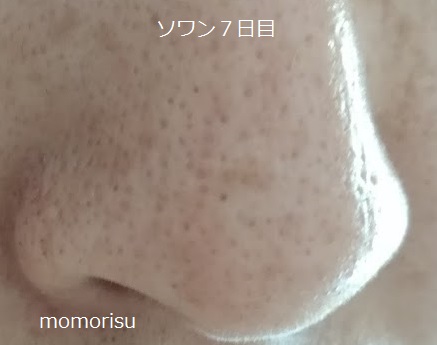 ソワンを使った毛穴の様子右側7日目