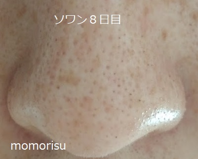 ソワンを使った毛穴の様子8日目