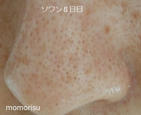 ソワンを使った毛穴の様子左側8日目
