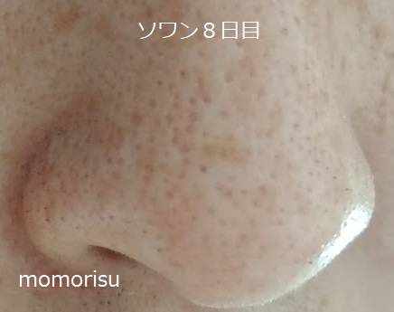 ソワンを使った毛穴の様子右側8日目