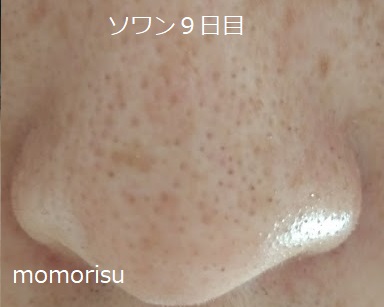 ソワンを使った毛穴の様子9日目