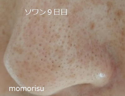 ソワンを使った毛穴の様子左側9日目