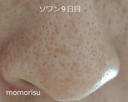 ソワンを使った毛穴の様子右側9日目