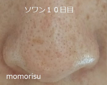 ソワンを使った毛穴の様子10日目