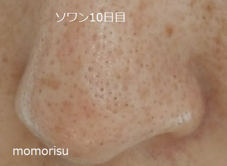 ソワンを使った毛穴の様子左側10日目