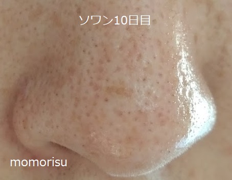 ソワンを使った毛穴の様子右側10日目