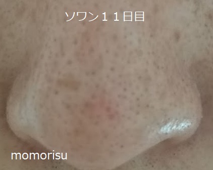 ソワンを使った毛穴の様子11日目