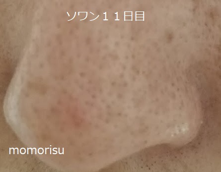 ソワンを使った毛穴の様子左側11日目