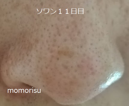 ソワンを使った毛穴の様子右側11日目