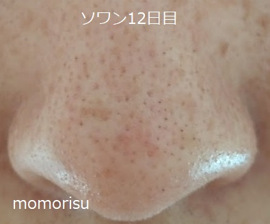 ソワンを使った毛穴の様子12日目
