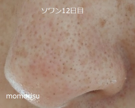 ソワンを使った毛穴の様子左側12日目
