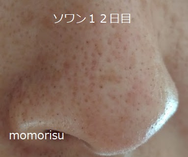 ソワンを使った毛穴の様子右側12日目