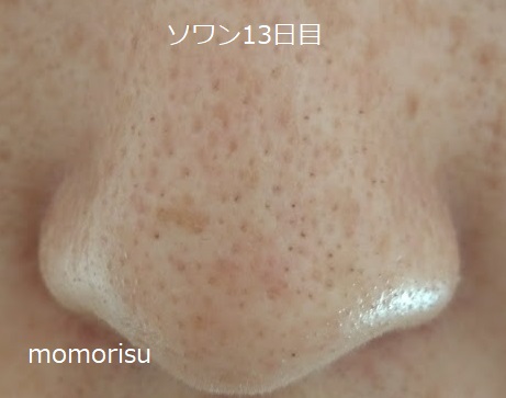ソワンを使った毛穴の様子13日目