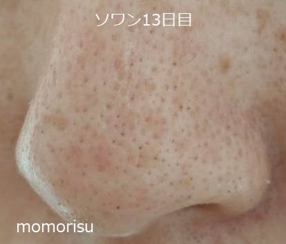 ソワンを使った毛穴の様子左側13日目