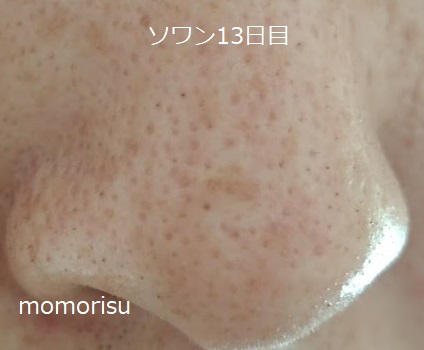 ソワンを使った毛穴の様子右側13日目