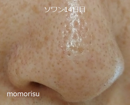 ソワンを使った毛穴の様子右側