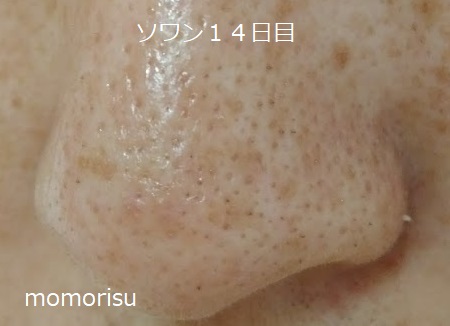 ソワンを使った毛穴の様子左側14日目