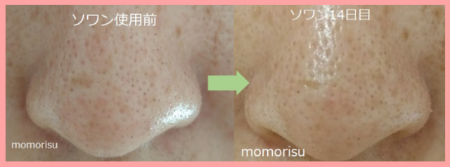 ソワン使用前と2週間後の比較画像 正面