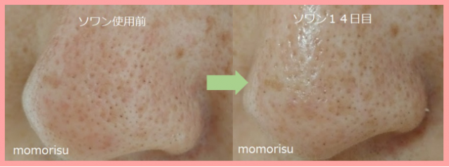 ソワン使用前と2週間後の比較画像 左側