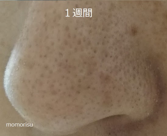 毛穴改善を始めて1週間目の毛穴の画像