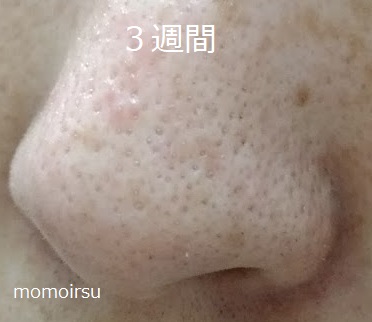 毛穴改善を始めてから3週間目の毛穴の画像