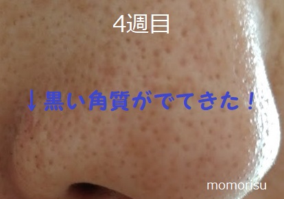 毛穴改善で4週目の黒ずみ角栓がある画像