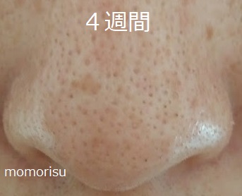 毛穴の4週間目の黒ずみ毛穴の画像