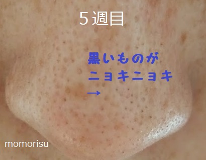 鼻の黒ずみ毛穴の様子で黒い角栓がでてきた画像