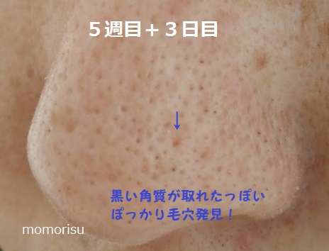 鼻の黒ずみ毛穴の角栓が取れた画像