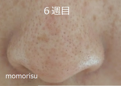鼻の黒ずみ毛穴の様子6週目