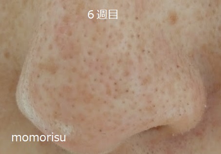 鼻の黒ずみ毛穴が少なくなってきた画像