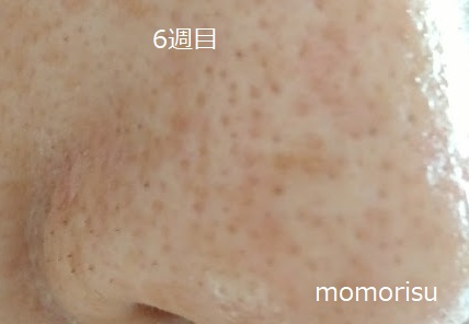 鼻の黒ずみ毛穴の横向きの様子6週目